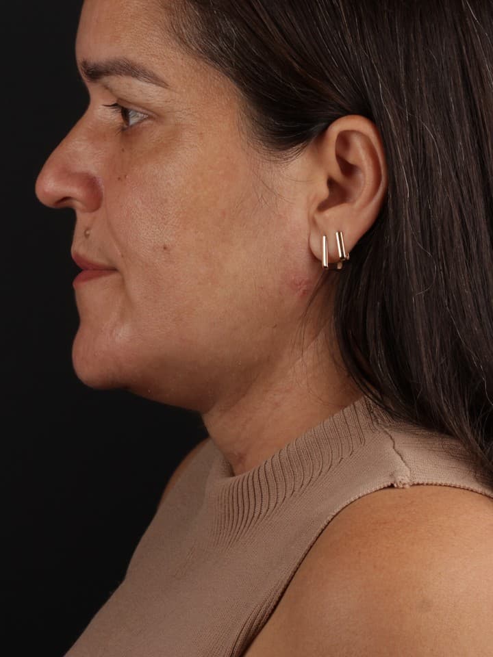 Cervicoplastia — antes e depois — Depois