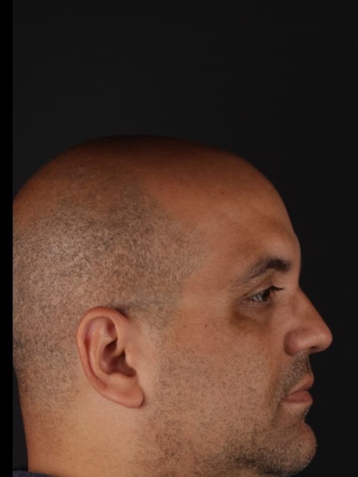 Cirurgia ortognática, antes e depois, Antes