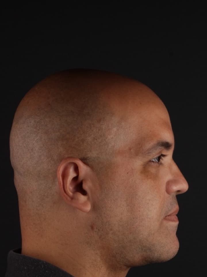 Cirurgia ortognática, antes e depois, Depois