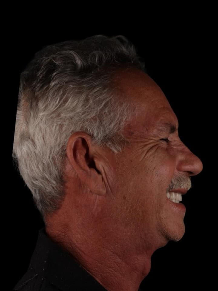 Implante zigomático — antes e depois — Depois